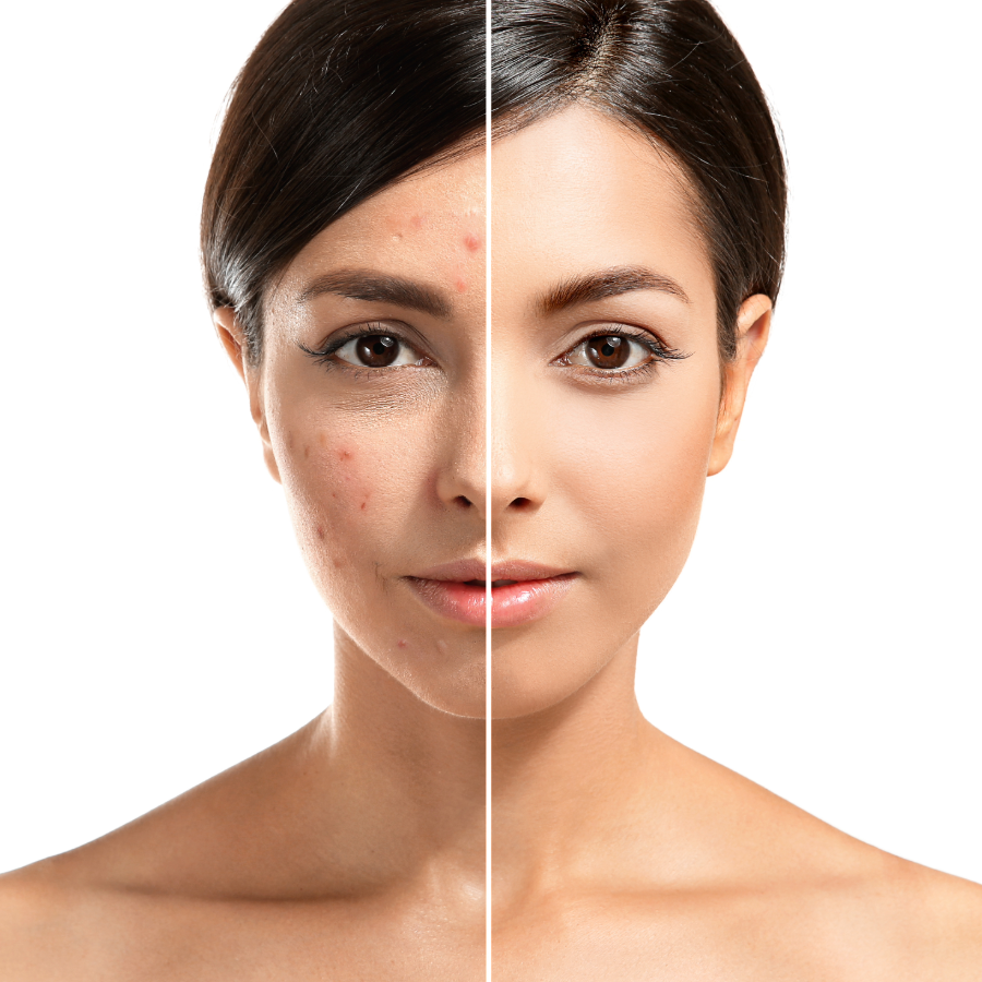 Top Feeling Acne Treatment Facial